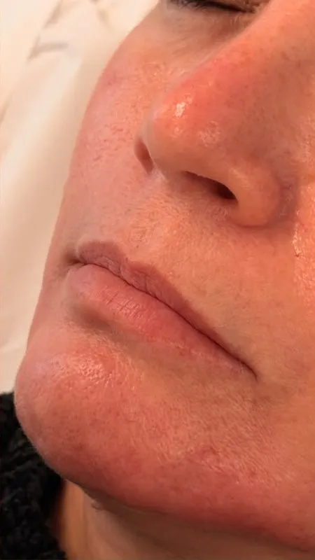 Preenchimento labial — antes
