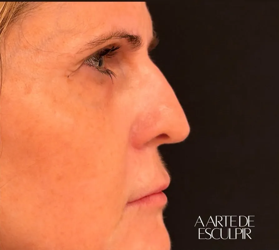 Rinomodelação, lábios e botox full face e pescoço — antes