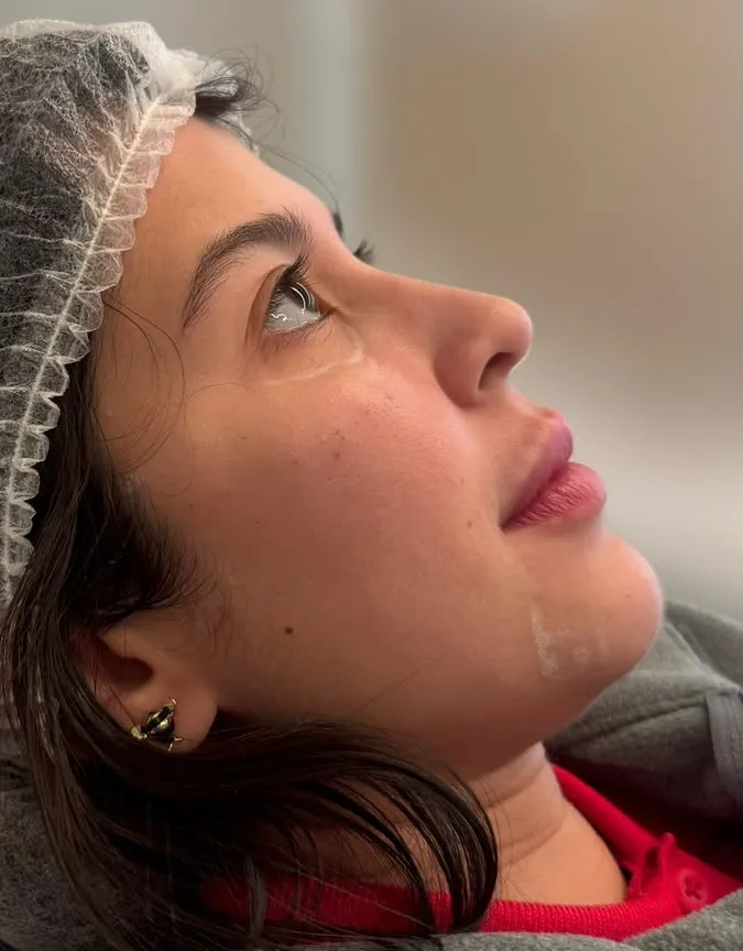 Preenchimento labial, nariz e top model look — antes