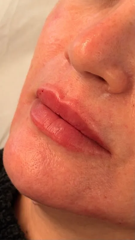 Preenchimento labial — depois