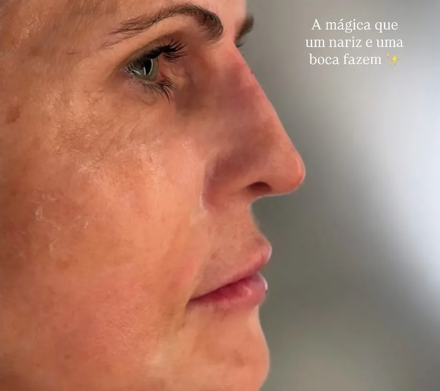 Rinomodelação, lábios e botox full face e pescoço — depois