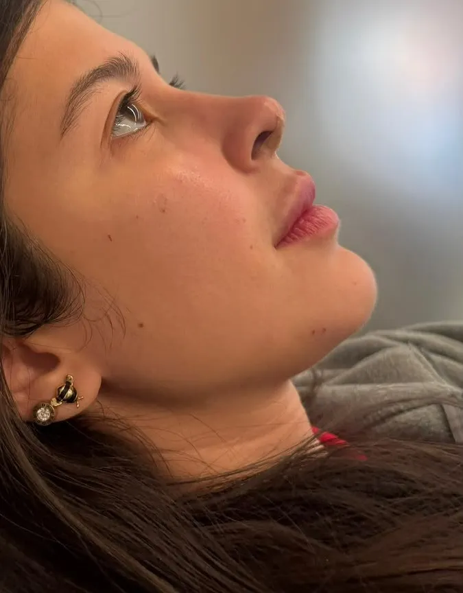 Preenchimento labial, nariz e top model look — depois
